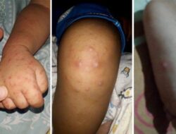 Penjelasan Apa Itu Flu Singapura, Penyakit Yang Menyerang Anak Saat Musim Peralihan